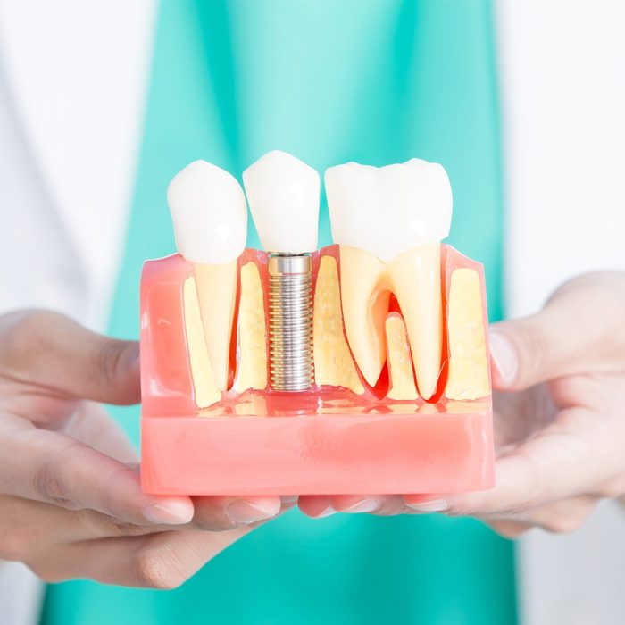 service-dentistry-implants