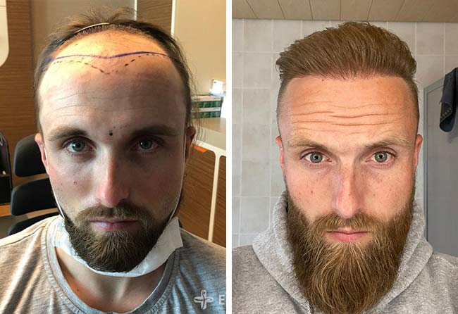 before-after-hair-transplant-fue-sapphire-3700-grafts-frederik-g